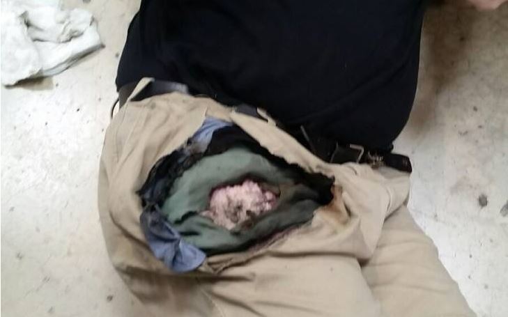 노트7 추가 자연발화 사고(화상).jpg | 인스티즈