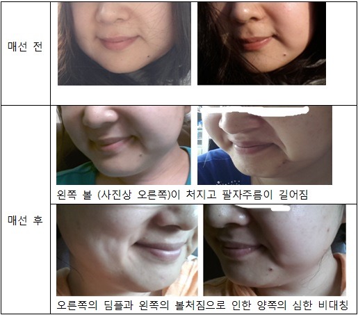 매선 부작용 후기 (매선 하지 마세요) | 인스티즈
