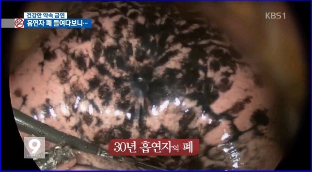 흡연자의 폐 | 인스티즈