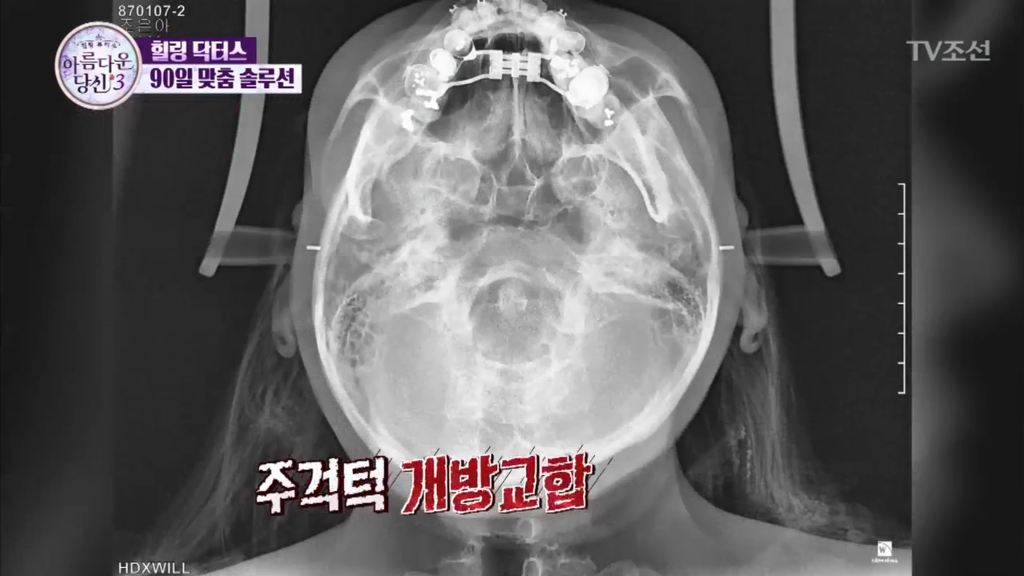 [렛미인역대급] 부정교합을 방치하면 안되는 이유 | 인스티즈