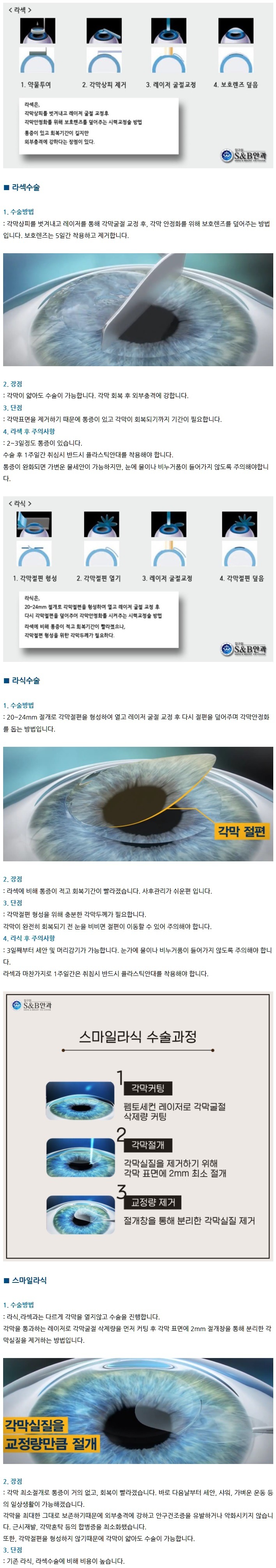 라섹 vs 라식 vs 스마일라식 비교 .jpg | 인스티즈